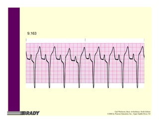 9.163
Gail Walraven, Basic Arrhythmias, Sixth Edition
©2006 by Pearson Education, Inc., Upper Saddle River, NJ
 