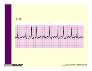 9.167
Gail Walraven, Basic Arrhythmias, Sixth Edition
©2006 by Pearson Education, Inc., Upper Saddle River, NJ
 