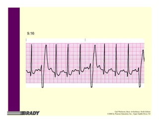 9.16
Gail Walraven, Basic Arrhythmias, Sixth Edition
©2006 by Pearson Education, Inc., Upper Saddle River, NJ
 