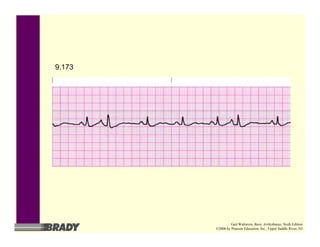 9.173
Gail Walraven, Basic Arrhythmias, Sixth Edition
©2006 by Pearson Education, Inc., Upper Saddle River, NJ
 