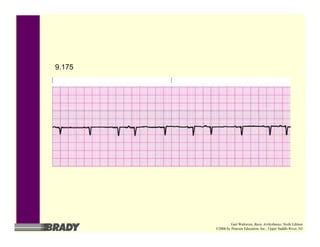 9.175
Gail Walraven, Basic Arrhythmias, Sixth Edition
©2006 by Pearson Education, Inc., Upper Saddle River, NJ
 
