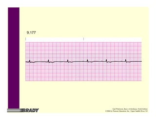 9.177
Gail Walraven, Basic Arrhythmias, Sixth Edition
©2006 by Pearson Education, Inc., Upper Saddle River, NJ
 