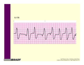 9.178
Gail Walraven, Basic Arrhythmias, Sixth Edition
©2006 by Pearson Education, Inc., Upper Saddle River, NJ
 