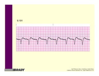 9.191
Gail Walraven, Basic Arrhythmias, Sixth Edition
©2006 by Pearson Education, Inc., Upper Saddle River, NJ
 