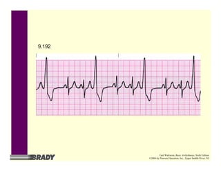 9.192
Gail Walraven, Basic Arrhythmias, Sixth Edition
©2006 by Pearson Education, Inc., Upper Saddle River, NJ
 