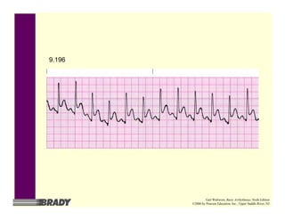9.196
Gail Walraven, Basic Arrhythmias, Sixth Edition
©2006 by Pearson Education, Inc., Upper Saddle River, NJ
 