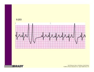 9.203
Gail Walraven, Basic Arrhythmias, Sixth Edition
©2006 by Pearson Education, Inc., Upper Saddle River, NJ
 