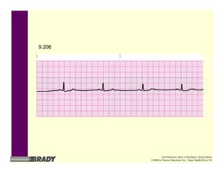 9.206
Gail Walraven, Basic Arrhythmias, Sixth Edition
©2006 by Pearson Education, Inc., Upper Saddle River, NJ
 