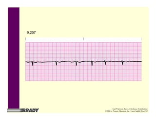 9.207
Gail Walraven, Basic Arrhythmias, Sixth Edition
©2006 by Pearson Education, Inc., Upper Saddle River, NJ
 