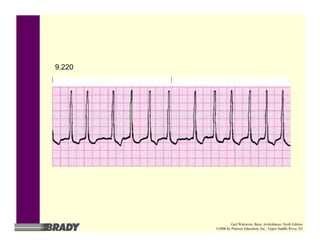 9.220
Gail Walraven, Basic Arrhythmias, Sixth Edition
©2006 by Pearson Education, Inc., Upper Saddle River, NJ
 