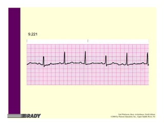 9.221
Gail Walraven, Basic Arrhythmias, Sixth Edition
©2006 by Pearson Education, Inc., Upper Saddle River, NJ
 
