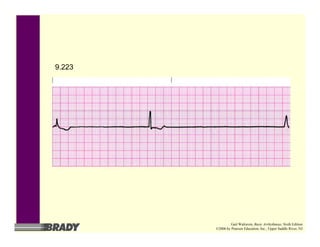 9.223
Gail Walraven, Basic Arrhythmias, Sixth Edition
©2006 by Pearson Education, Inc., Upper Saddle River, NJ
 