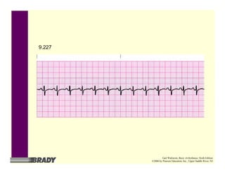 9.227
Gail Walraven, Basic Arrhythmias, Sixth Edition
©2006 by Pearson Education, Inc., Upper Saddle River, NJ
 
