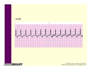9.228
Gail Walraven, Basic Arrhythmias, Sixth Edition
©2006 by Pearson Education, Inc., Upper Saddle River, NJ
 