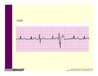 9.229
Gail Walraven, Basic Arrhythmias, Sixth Edition
©2006 by Pearson Education, Inc., Upper Saddle River, NJ
 