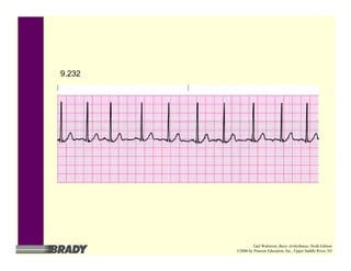 9.232
Gail Walraven, Basic Arrhythmias, Sixth Edition
©2006 by Pearson Education, Inc., Upper Saddle River, NJ
 