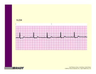 9.234
Gail Walraven, Basic Arrhythmias, Sixth Edition
©2006 by Pearson Education, Inc., Upper Saddle River, NJ
 