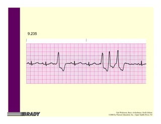 9.235
Gail Walraven, Basic Arrhythmias, Sixth Edition
©2006 by Pearson Education, Inc., Upper Saddle River, NJ
 