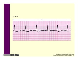 9.239
Gail Walraven, Basic Arrhythmias, Sixth Edition
©2006 by Pearson Education, Inc., Upper Saddle River, NJ
 