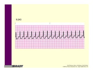9.243
Gail Walraven, Basic Arrhythmias, Sixth Edition
©2006 by Pearson Education, Inc., Upper Saddle River, NJ
 
