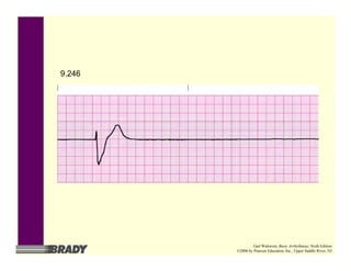 9.246
Gail Walraven, Basic Arrhythmias, Sixth Edition
©2006 by Pearson Education, Inc., Upper Saddle River, NJ
 