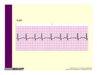 9.247
Gail Walraven, Basic Arrhythmias, Sixth Edition
©2006 by Pearson Education, Inc., Upper Saddle River, NJ
 