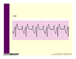 9.28
Gail Walraven, Basic Arrhythmias, Sixth Edition
©2006 by Pearson Education, Inc., Upper Saddle River, NJ
 