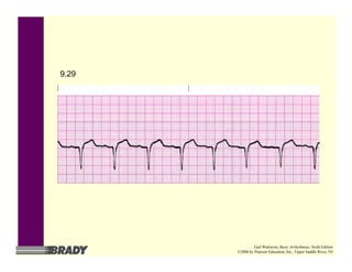 9.29
Gail Walraven, Basic Arrhythmias, Sixth Edition
©2006 by Pearson Education, Inc., Upper Saddle River, NJ
 
