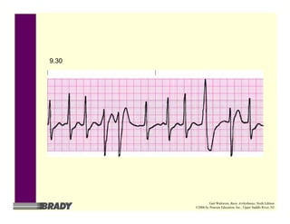 9.30
Gail Walraven, Basic Arrhythmias, Sixth Edition
©2006 by Pearson Education, Inc., Upper Saddle River, NJ
 