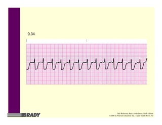 9.34
Gail Walraven, Basic Arrhythmias, Sixth Edition
©2006 by Pearson Education, Inc., Upper Saddle River, NJ
 