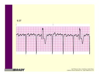 9.37
Gail Walraven, Basic Arrhythmias, Sixth Edition
©2006 by Pearson Education, Inc., Upper Saddle River, NJ
 