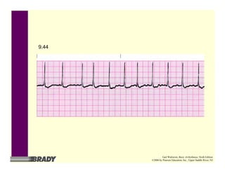 9.44
Gail Walraven, Basic Arrhythmias, Sixth Edition
©2006 by Pearson Education, Inc., Upper Saddle River, NJ
 