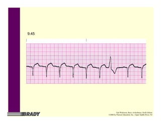 9.45
Gail Walraven, Basic Arrhythmias, Sixth Edition
©2006 by Pearson Education, Inc., Upper Saddle River, NJ
 