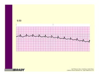 9.50
Gail Walraven, Basic Arrhythmias, Sixth Edition
©2006 by Pearson Education, Inc., Upper Saddle River, NJ
 