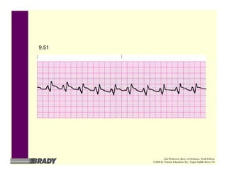 9.51
Gail Walraven, Basic Arrhythmias, Sixth Edition
©2006 by Pearson Education, Inc., Upper Saddle River, NJ
 