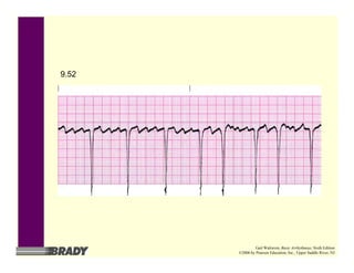 9.52
Gail Walraven, Basic Arrhythmias, Sixth Edition
©2006 by Pearson Education, Inc., Upper Saddle River, NJ
 