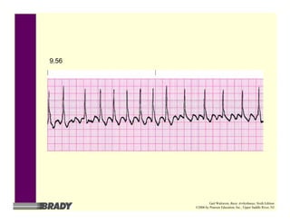 9.56
Gail Walraven, Basic Arrhythmias, Sixth Edition
©2006 by Pearson Education, Inc., Upper Saddle River, NJ
 