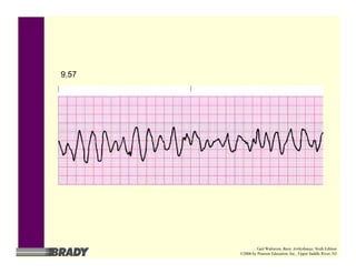 9.57
Gail Walraven, Basic Arrhythmias, Sixth Edition
©2006 by Pearson Education, Inc., Upper Saddle River, NJ
 