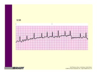 9.58
Gail Walraven, Basic Arrhythmias, Sixth Edition
©2006 by Pearson Education, Inc., Upper Saddle River, NJ
 