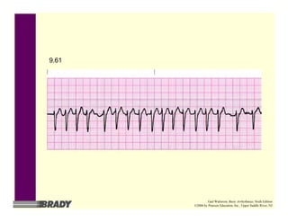 9.61
Gail Walraven, Basic Arrhythmias, Sixth Edition
©2006 by Pearson Education, Inc., Upper Saddle River, NJ
 