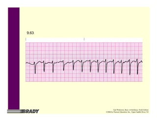 9.63
Gail Walraven, Basic Arrhythmias, Sixth Edition
©2006 by Pearson Education, Inc., Upper Saddle River, NJ
 
