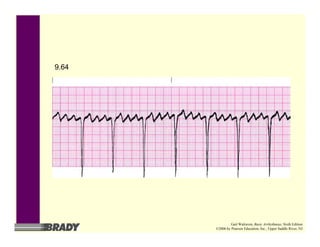9.64
Gail Walraven, Basic Arrhythmias, Sixth Edition
©2006 by Pearson Education, Inc., Upper Saddle River, NJ
 