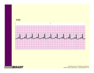 9.66
Gail Walraven, Basic Arrhythmias, Sixth Edition
©2006 by Pearson Education, Inc., Upper Saddle River, NJ
 