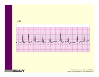 9.67
Gail Walraven, Basic Arrhythmias, Sixth Edition
©2006 by Pearson Education, Inc., Upper Saddle River, NJ
 