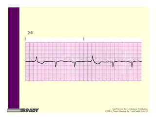9.6
Gail Walraven, Basic Arrhythmias, Sixth Edition
©2006 by Pearson Education, Inc., Upper Saddle River, NJ
 