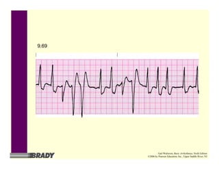 9.69
Gail Walraven, Basic Arrhythmias, Sixth Edition
©2006 by Pearson Education, Inc., Upper Saddle River, NJ
 