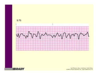 9.70
Gail Walraven, Basic Arrhythmias, Sixth Edition
©2006 by Pearson Education, Inc., Upper Saddle River, NJ
 