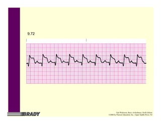 9.72
Gail Walraven, Basic Arrhythmias, Sixth Edition
©2006 by Pearson Education, Inc., Upper Saddle River, NJ
 