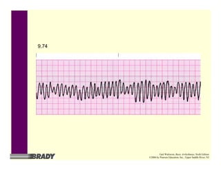 9.74
Gail Walraven, Basic Arrhythmias, Sixth Edition
©2006 by Pearson Education, Inc., Upper Saddle River, NJ
 