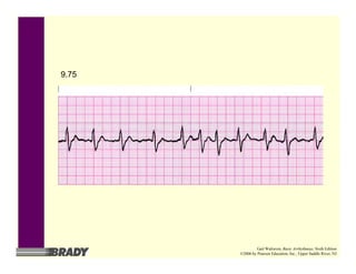 9.75
Gail Walraven, Basic Arrhythmias, Sixth Edition
©2006 by Pearson Education, Inc., Upper Saddle River, NJ
 